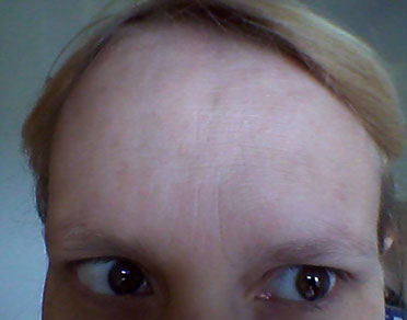 At rest after Bocouture botulinum toxin treatment